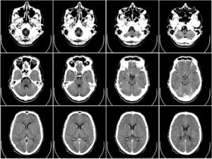 pixabay computer tomography ct radiography brain x ray 4x3 images